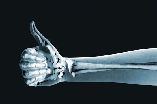 الأشعة السينية لتشخيص آلام مفاصل الأصابع