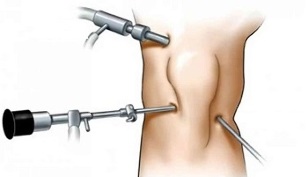 تنظير المفصل من أجل التهاب المفاصل في مفصل الركبة